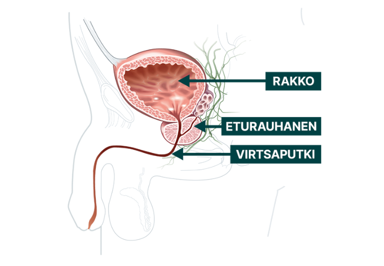 4 merkkiä normaalista eturauhasesta